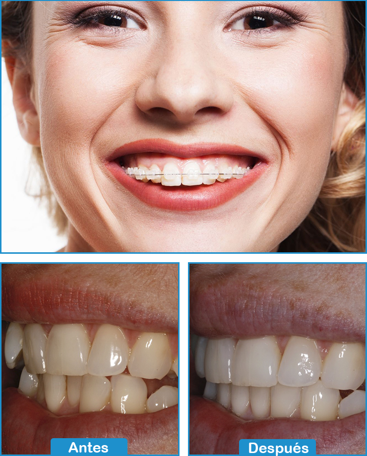 Ortodoncia Invicible