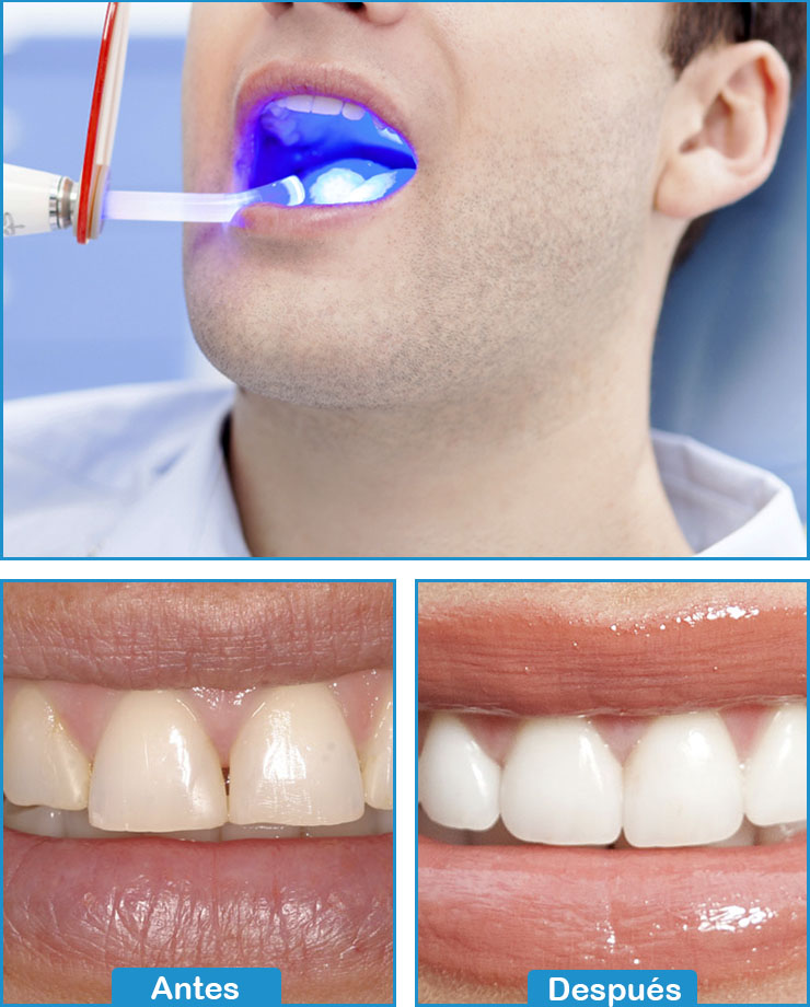 Blanqueamiento Dental
